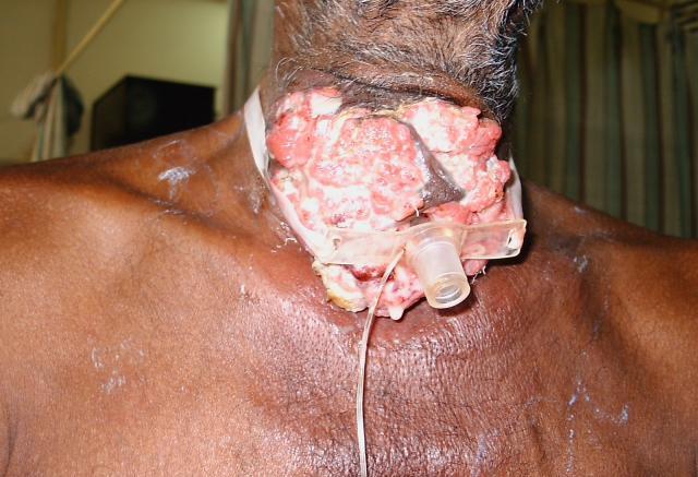 Herpes on Neck Pictures – 8 Photos & Images / illnessee.com